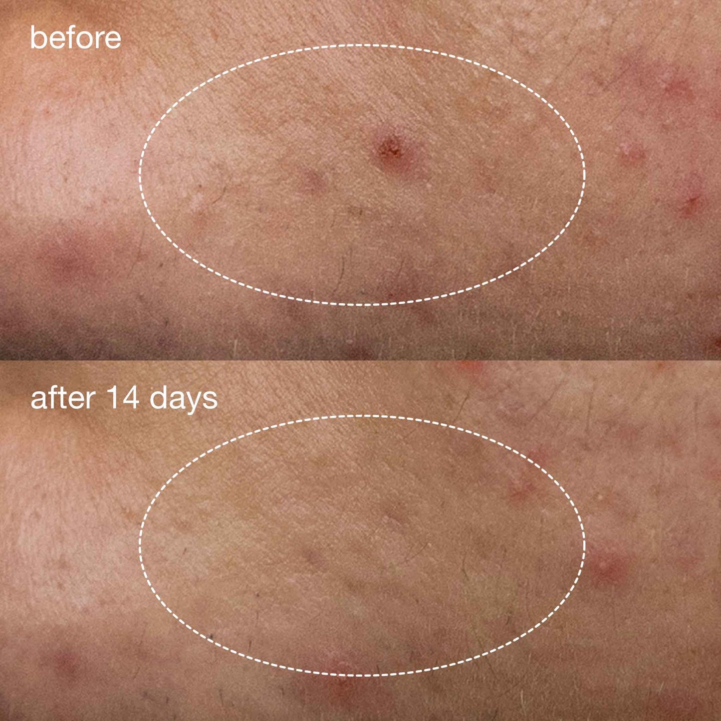 Deep Acne Liquid Patch (8426227597642)